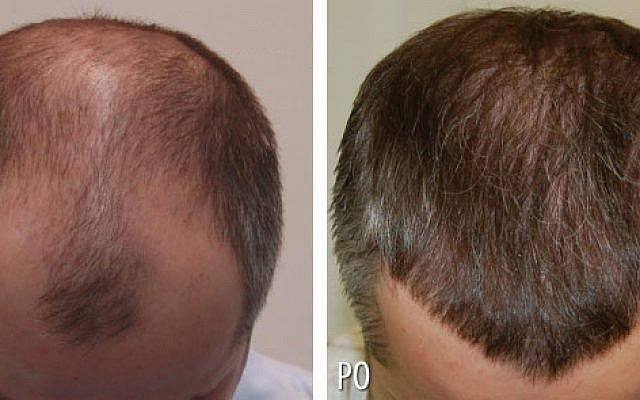 Know The Reality Of Hair Transplantation