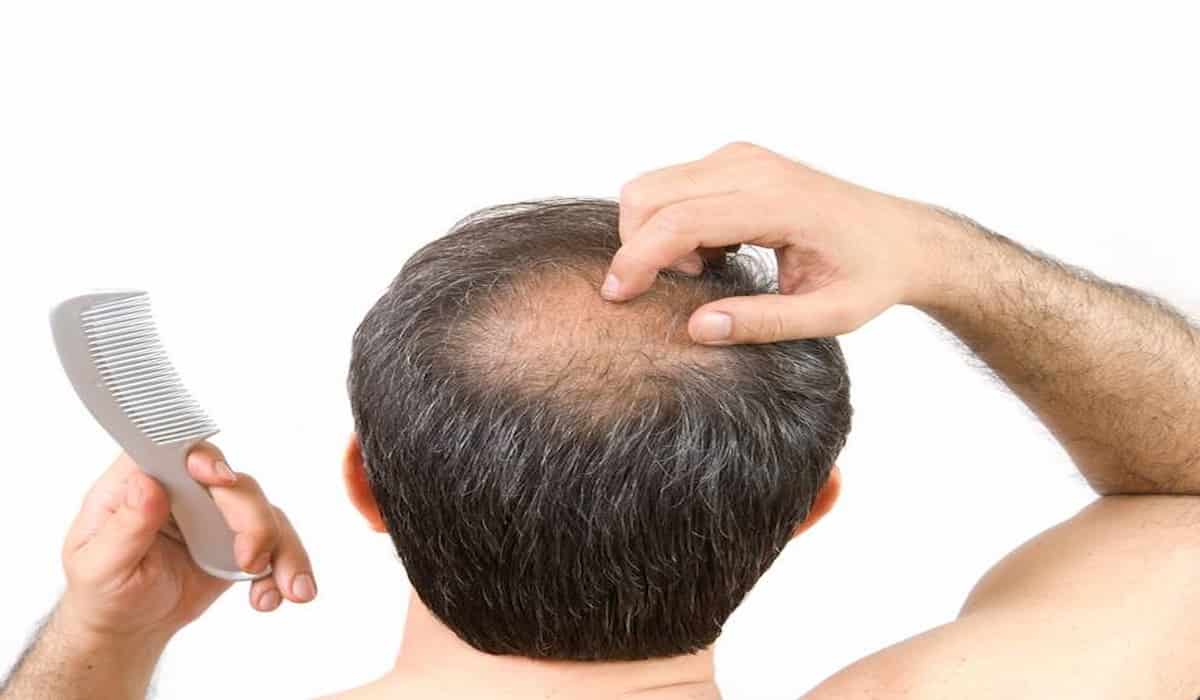 Hair Loss Corona